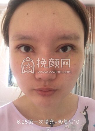 悦丽汇陶主任自体脂肪填充,假体眉弓,蛋白线