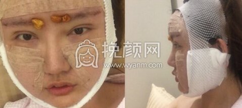 悦丽汇陶主任自体脂肪填充,假体眉弓,蛋白线