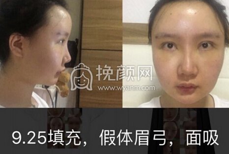 悦丽汇陶主任自体脂肪填充,假体眉弓,蛋白线