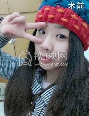 成都良好美妍徐彬全切双眼皮开内眼角,提肌