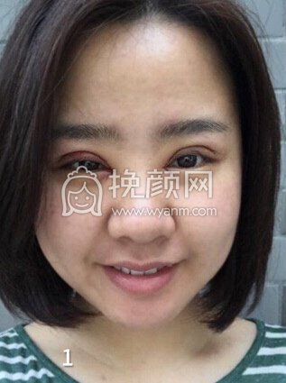 成都良好美妍徐彬全切双眼皮开内眼角,提肌