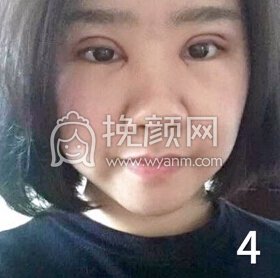 成都良好美妍徐彬全切双眼皮开内眼角,提肌
