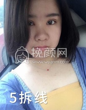 成都良好美妍徐彬全切双眼皮开内眼角,提肌
