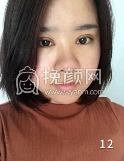 成都良好美妍徐彬全切双眼皮开内眼角,提肌