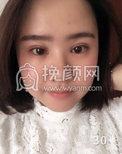 成都良好美妍徐彬全切双眼皮开内眼角,提肌