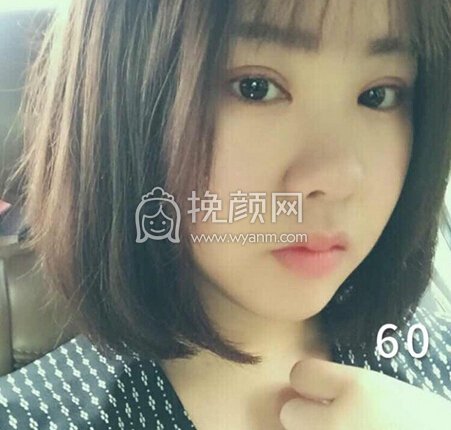 成都良好美妍徐彬全切双眼皮开内眼角,提肌