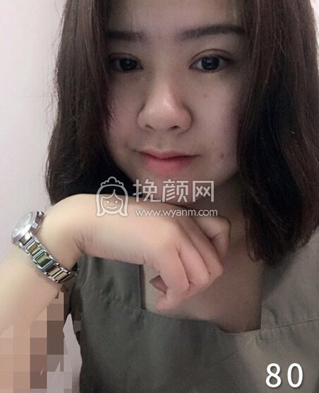 成都良好美妍徐彬全切双眼皮开内眼角,提肌