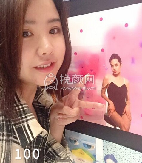 成都良好美妍徐彬全切双眼皮开内眼角,提肌