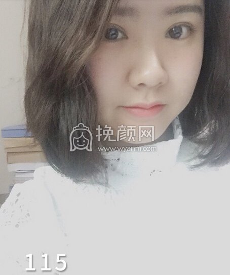 成都良好美妍徐彬全切双眼皮开内眼角,提肌