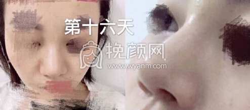 广州博仕整形张建军医生做的鼻修复