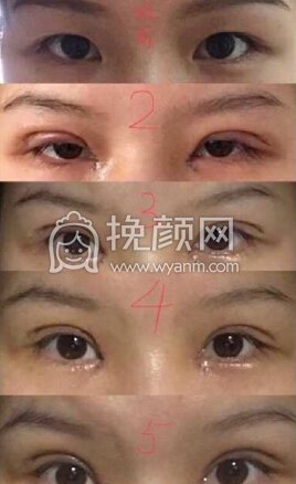 南京江苏省中医院王金明医生双眼皮+开眼角