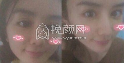 深圳贝漾美天找曹思佳医生做的双眼皮+开眼角