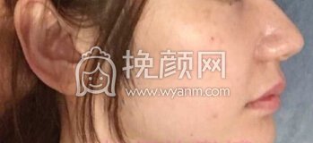 深圳李信锋鼻部手术+鼻基底+膨体山根