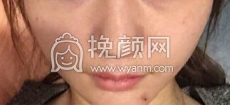 深圳李信锋鼻部手术+鼻基底+膨体山根