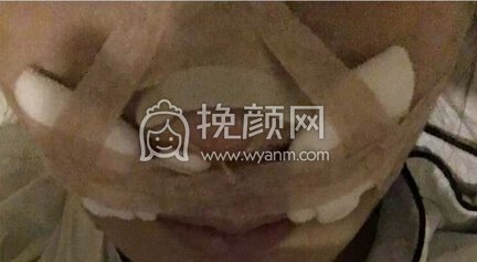 深圳李信锋鼻部手术+鼻基底+膨体山根