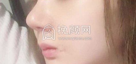 深圳李信锋鼻部手术+鼻基底+膨体山根