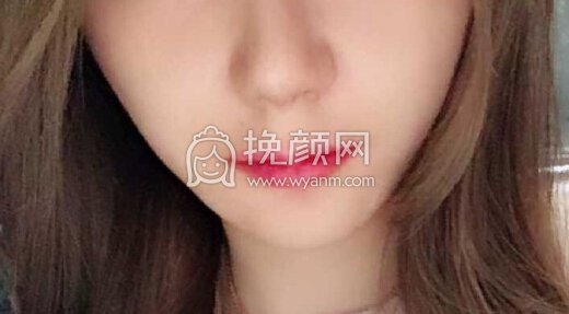 深圳李信锋鼻部手术+鼻基底+膨体山根
