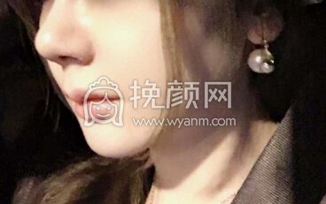 深圳李信锋鼻部手术+鼻基底+膨体山根