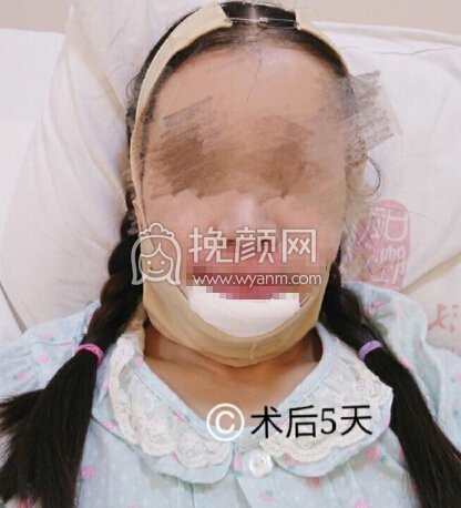 武汉武大口腔杨学文正颌手术,双颌+颌成形