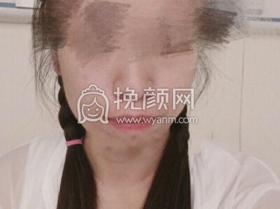 武汉武大口腔杨学文正颌手术,双颌+颌成形