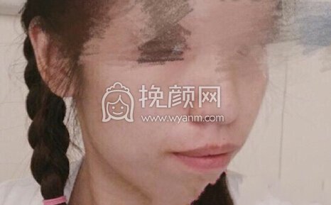 武汉武大口腔杨学文正颌手术,双颌+颌成形