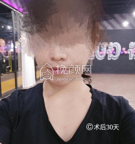 武汉武大口腔杨学文正颌手术,双颌+颌成形