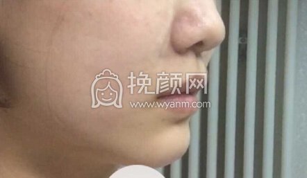北京丹熙张正韬医生做的鼻基底,材料是膨体