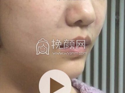 北京丹熙张正韬医生做的鼻基底,材料是膨体