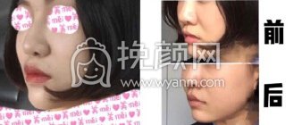 北京丹熙张正韬医生做的鼻基底,材料是膨体