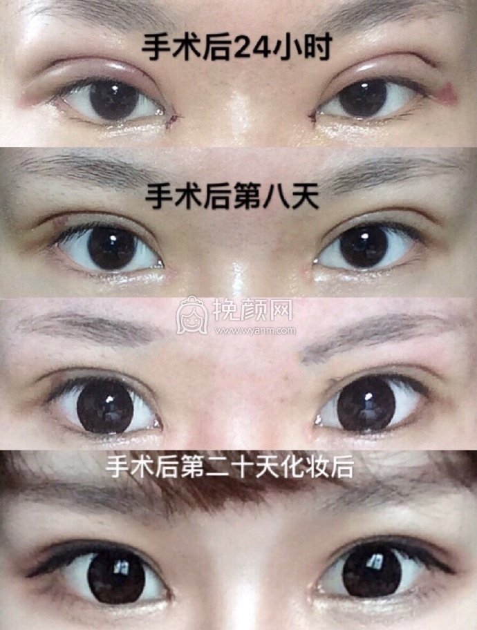 南京市东南大学附属中大医院郭芳芳双眼皮+开