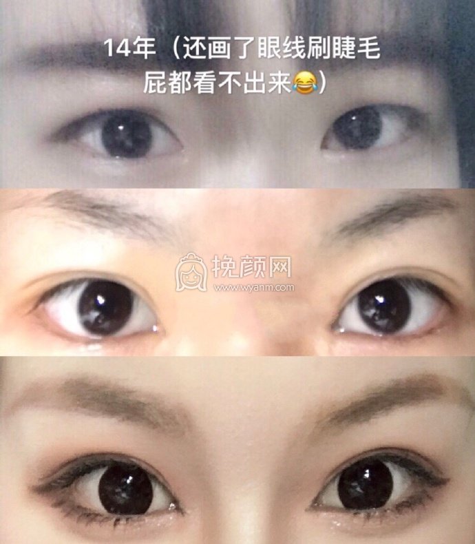 南京市东南大学附属中大医院郭芳芳双眼皮+开