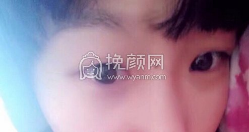 天津伊美尔白金子眼部手术,面部脂肪填充,鼻子