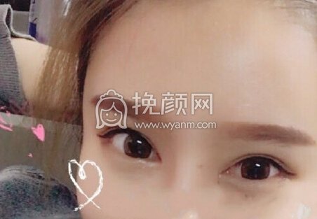 天津伊美尔白金子眼部手术,面部脂肪填充,鼻子