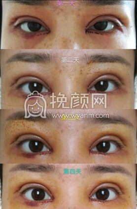 南京医科大学第二附属医院李昌主任双眼皮+开