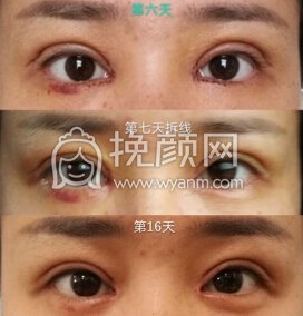 南京医科大学第二附属医院李昌主任双眼皮+开