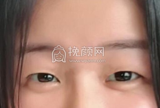南京医科大学第二附属医院李昌主任双眼皮+开