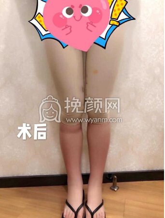 成都西婵李斌医生做的大腿抽脂