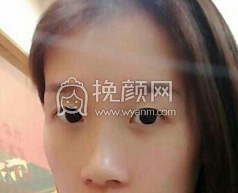 长沙美德思彭青和医生开内眼角加微创双眼皮