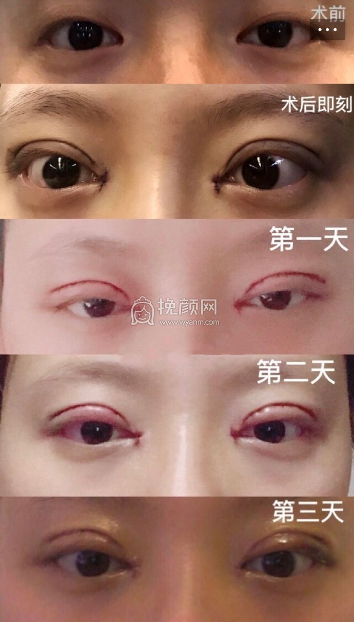 成都景华医学美容江涛全切双眼皮+开眼角+提