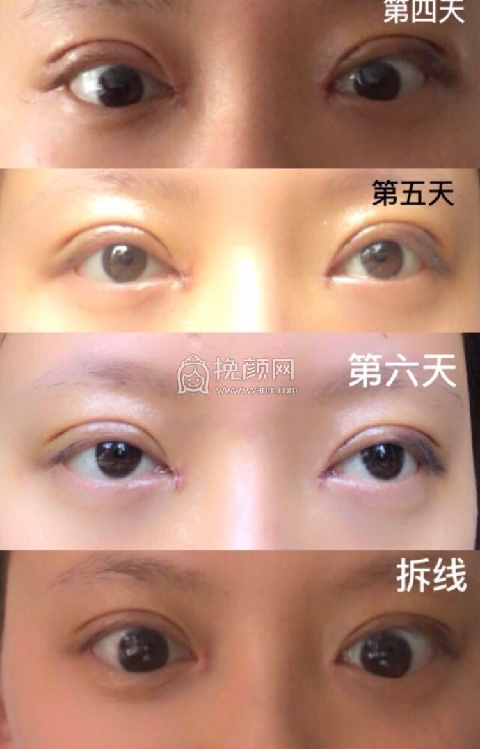 成都景华医学美容江涛全切双眼皮+开眼角+提
