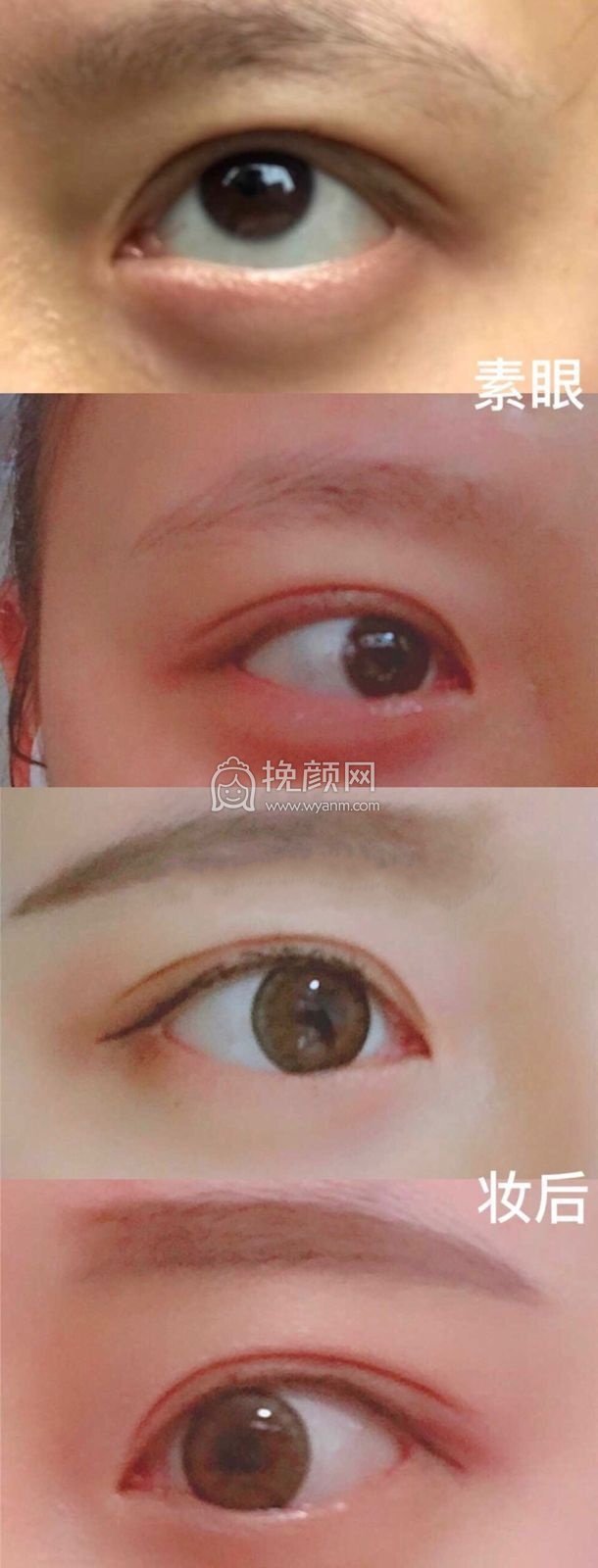 成都景华医学美容江涛全切双眼皮+开眼角+提