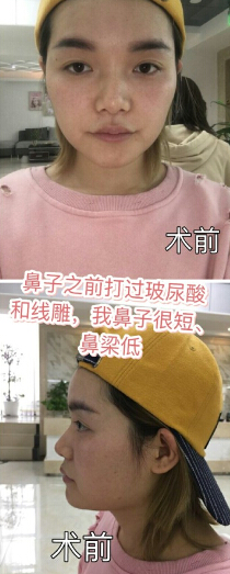 重庆术妍整形汪志强医生隆鼻部手术