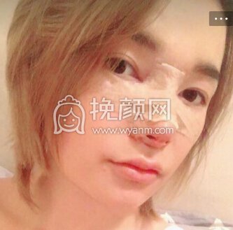 重庆术妍整形汪志强医生隆鼻部手术