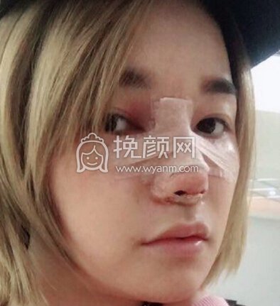 重庆术妍整形汪志强医生隆鼻部手术