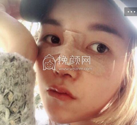 重庆术妍整形汪志强医生隆鼻部手术