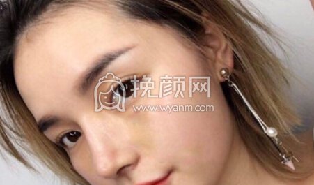 重庆术妍整形汪志强医生隆鼻部手术