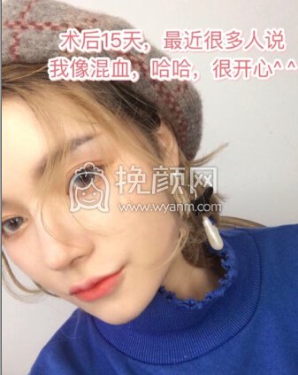 重庆术妍整形汪志强医生隆鼻部手术
