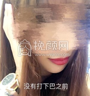 广州晨曦美容医院李宗磊注射瘦脸及玻尿酸垫下巴