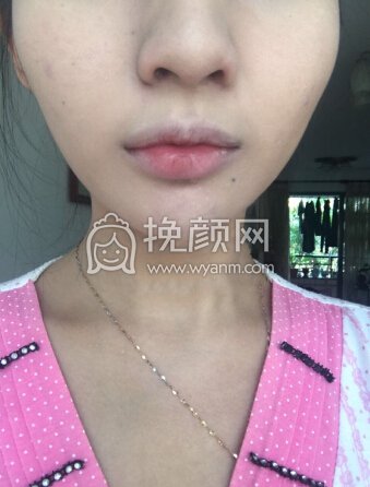 广州晨曦美容医院李宗磊注射瘦脸及玻尿酸垫下巴