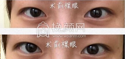 武汉同济周光瑜全切双眼皮+内眼角